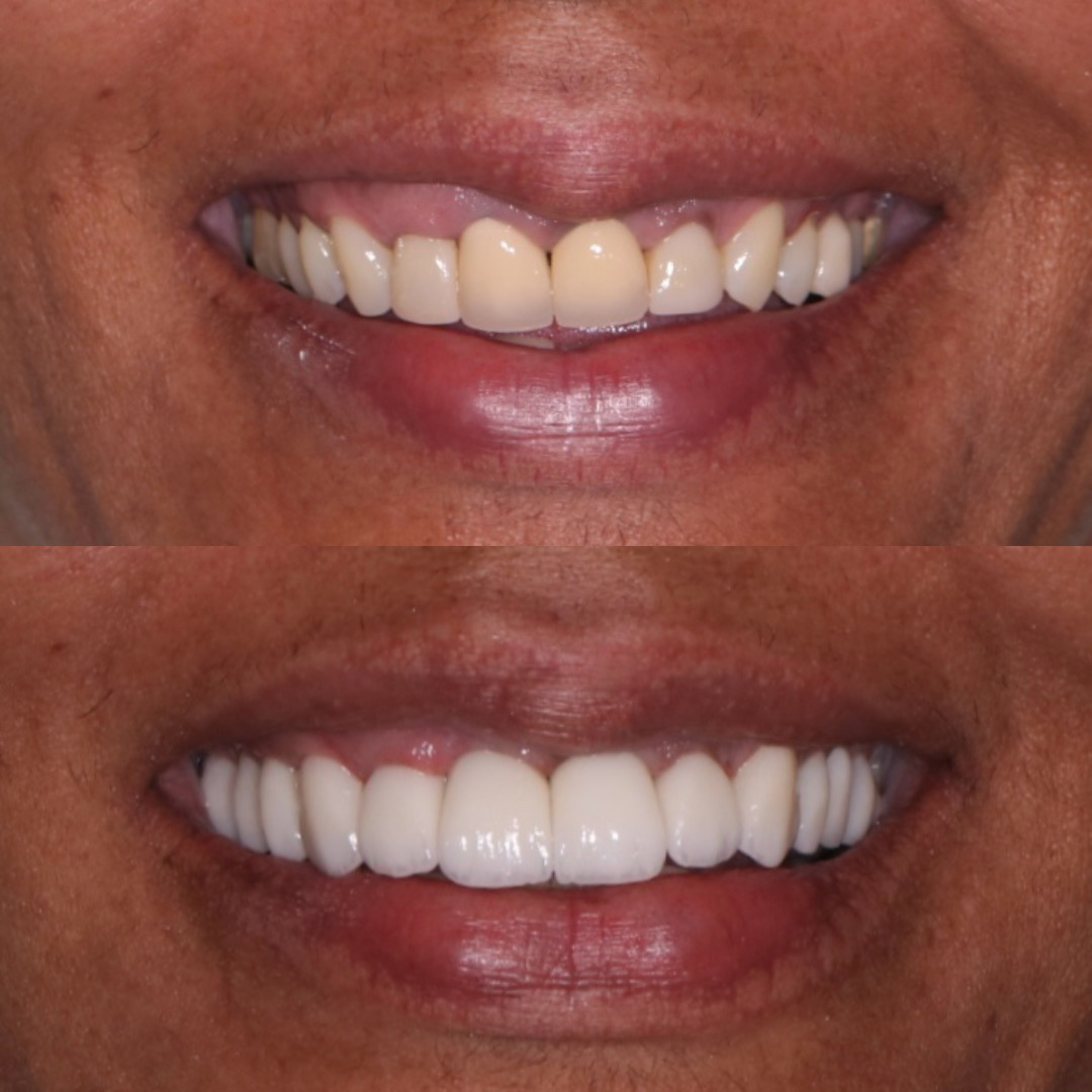 Caso clínico - Clareamento dental